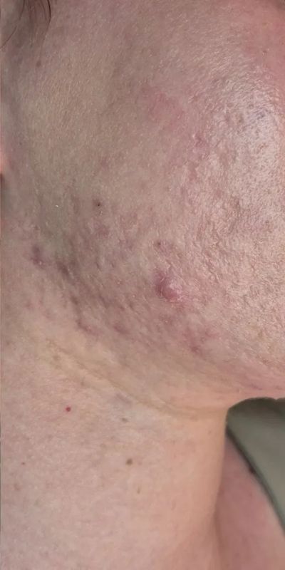 Postinflamatorne hiperpigmentacije posle terapije