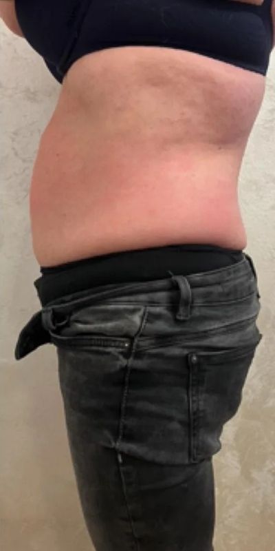 Rezultati kriolipolize stomak posle 5 tretmana