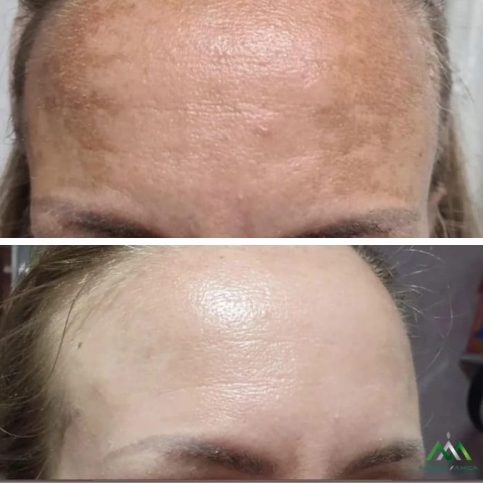 Terapija za hiperpigmentacije i melazmu Beograd &ndash; Dr. Kaliterna rutina i profesionalni tretmani