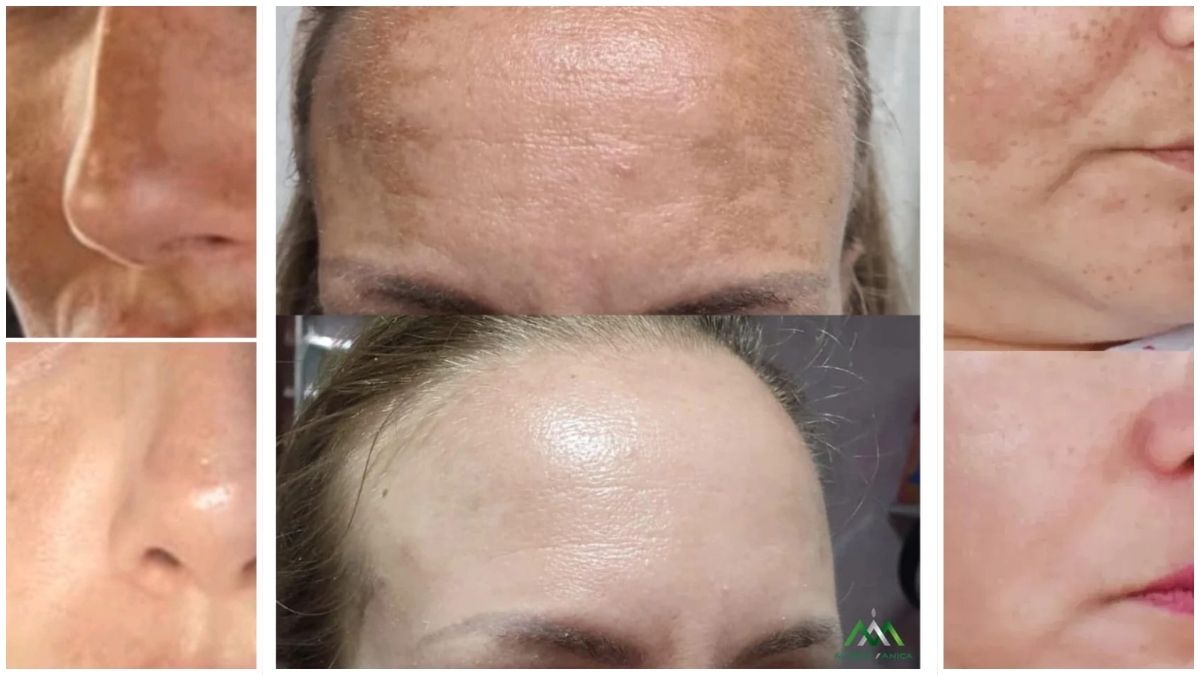 Terapija za hiperpigmentaciju i melazmu u salonu Mystic Anica Beograd