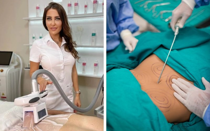 Poređenje kriolipolize i liposukcije za oblikovanje tela u salonu Mystic Anica Beograd